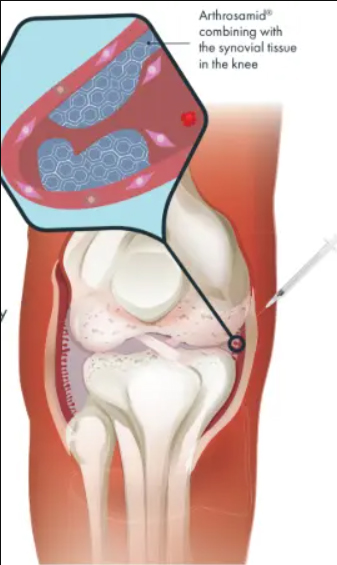 Arthrosamid® Knee Injection