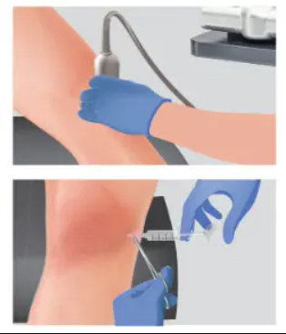 Arthrosamid® Knee Injection