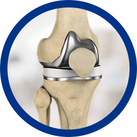 Joint Replacement