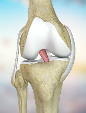 ACL Knee Reconstruction