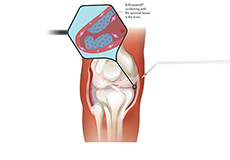 Arthrosamid® Knee Injection