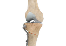 High Tibial Osteotomy