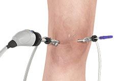 Knee Arthroscopy