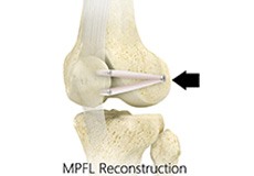 Medial Patellofemoral Ligament Reconstruction