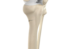 Tibia Fractures